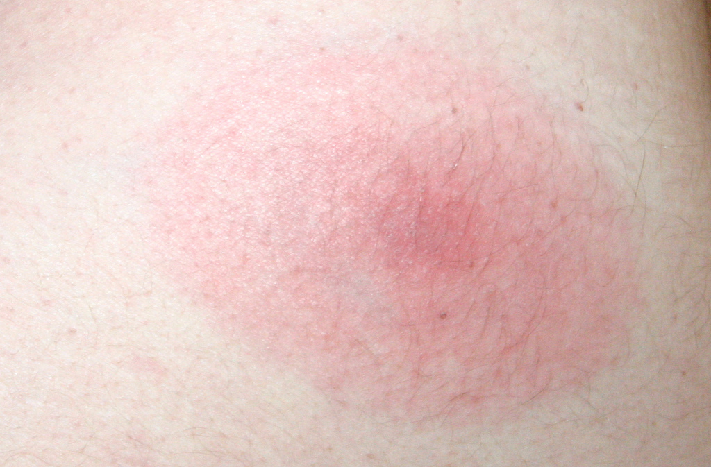 picture of lyme disease bite #10