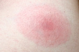 Deer Tick Bite & Lyme Disease Rash