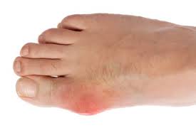 Gout Natural Prevention