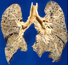 Emphysema Smoking Lungs